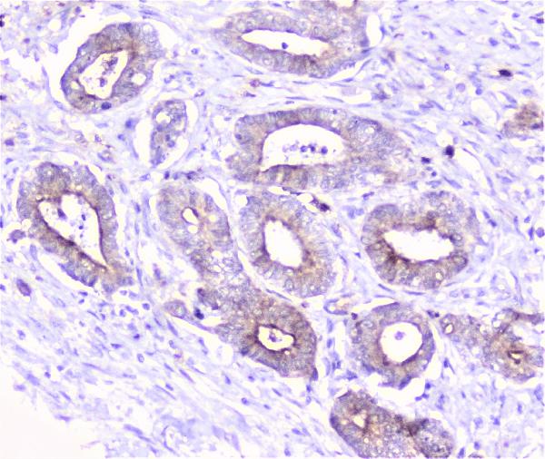 IHC analysis of COMP using anti-COMP antibody (A02443-1). COMP was detected in paraffin-embedded section of human cholangiocarcinoma tissue. Heat mediated antigen retrieval was performed in citrate buffer (pH6, epitope retrieval solution) for 20 mins. The tissue section was blocked with 10% goat serum. The tissue section was then incubated with 1μg/ml rabbit anti-COMP Antibody (A02443-1) overnight at 4°C. Biotinylated goat anti-rabbit IgG was used as secondary antibody and incubated for 30 minutes at 37°C. The tissue section was developed using Strepavidin-Biotin-Complex (SABC)(Catalog # SA1022) with DAB as the chromogen.