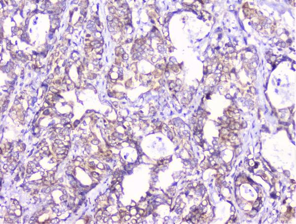 IHC analysis of COMP using anti-COMP antibody (A02443-1). COMP was detected in paraffin-embedded section of human gastric cancer tissue. Heat mediated antigen retrieval was performed in citrate buffer (pH6, epitope retrieval solution) for 20 mins. The tissue section was blocked with 10% goat serum. The tissue section was then incubated with 1μg/ml rabbit anti-COMP Antibody (A02443-1) overnight at 4°C. Biotinylated goat anti-rabbit IgG was used as secondary antibody and incubated for 30 minutes at 37°C. The tissue section was developed using Strepavidin-Biotin-Complex (SABC)(Catalog # SA1022) with DAB as the chromogen.