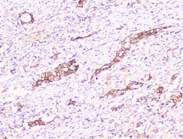 IHC analysis of COMP using anti-COMP antibody (A02443-1). COMP was detected in paraffin-embedded section of human intestinal cancer tissue. Heat mediated antigen retrieval was performed in citrate buffer (pH6, epitope retrieval solution) for 20 mins. The tissue section was blocked with 10% goat serum. The tissue section was then incubated with 1μg/ml rabbit anti-COMP Antibody (A02443-1) overnight at 4°C. Biotinylated goat anti-rabbit IgG was used as secondary antibody and incubated for 30 minutes at 37°C. The tissue section was developed using Strepavidin-Biotin-Complex (SABC)(Catalog # SA1022) with DAB as the chromogen.