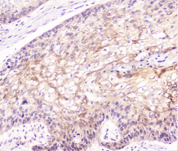 IHC analysis of COMP using anti-COMP antibody (A02443-1). COMP was detected in paraffin-embedded section of human oesophagus squama cancer tissue. Heat mediated antigen retrieval was performed in citrate buffer (pH6, epitope retrieval solution) for 20 mins. The tissue section was blocked with 10% goat serum. The tissue section was then incubated with 1μg/ml rabbit anti-COMP Antibody (A02443-1) overnight at 4°C. Biotinylated goat anti-rabbit IgG was used as secondary antibody and incubated for 30 minutes at 37°C. The tissue section was developed using Strepavidin-Biotin-Complex (SABC)(Catalog # SA1022) with DAB as the chromogen.