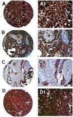 Immunohistochemisty of FAP-1 in formalin-fixed, paraffin embedded ovarian carcinoma cores from a tissue microarray using primary antibody dilution ratio of 1:2000