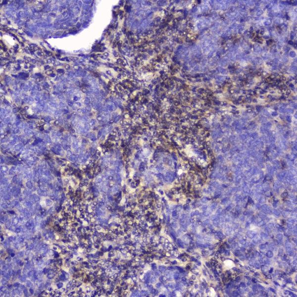 IHC analysis of Talin 1 using anti-Talin 1 antibody (A02859-1). Talin 1 was detected in paraffin-embedded section of human Lung cancer tissue. Heat mediated antigen retrieval was performed in citrate buffer (pH6, epitope retrieval solution) for 20 mins. The tissue section was blocked with 10% goat serum. The tissue section was then incubated with 2μg/ml rabbit anti-Talin 1 Antibody (A02859-1) overnight at 4℃. Biotinylated goat anti-rabbit IgG was used as secondary antibody and incubated for 30 minutes at 37℃. The tissue section was developed using Strepavidin-Biotin-Complex (SABC)(Catalog # SA1022) with DAB as the chromogen.
