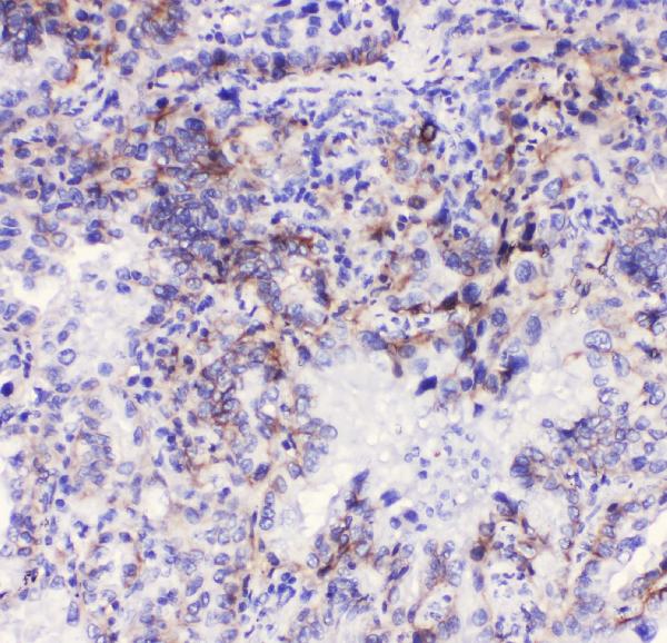 IHC analysis of Integrin alpha 3 using anti-Integrin alpha 3 antibody (A02902). Integrin alpha 3 was detected in paraffin-embedded section of human lung cancer tissue. Heat mediated antigen retrieval was performed in citrate buffer (pH6, epitope retrieval solution) for 20 mins. The tissue section was blocked with 10% goat serum. The tissue section was then incubated with 1μg/ml rabbit anti-Integrin alpha 3 Antibody (A02902) overnight at 4°C. Biotinylated goat anti-rabbit IgG was used as secondary antibody and incubated for 30 minutes at 37°C. The tissue section was developed using Strepavidin-Biotin-Complex (SABC)(Catalog # SA1022) with DAB as the chromogen.