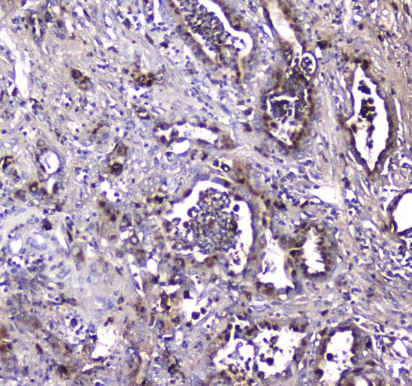Figure 3. IHC analysis of LGALS3BP using anti-LGALS3BP antibody (A02938-1). LGALS3BP was detected in paraffin-embedded section of human intestinal cancer tissue. Heat mediated antigen retrieval was performed in citrate buffer (pH6, epitope retrieval solution) for 20 mins. The tissue section was blocked with 10% goat serum. The tissue section was then incubated with 2microg/ml rabbit anti-LGALS3BP Antibody (A02938-1) overnight at 4°C. Biotinylated goat anti-rabbit IgG was used as secondary antibody and incubated for 30 minutes at 37°C. The tissue section was developed using Strepavidin-Biotin-Complex (SABC)(Catalog # SA1022) with DAB as the chromogen. Figure 3. IHC analysis of LGALS3BP using anti-LGALS3BP antibody (A02938-1). LGALS3BP was detected in paraffin-embedded section of human intestinal cancer tissue. Heat mediated antigen retrieval was performed in citrate buffer (pH6, epitope retrieval solution) for 20 mins. The tissue section was blocked with 10% goat serum. The tissue section was then incubated with 2microg/ml rabbit anti-LGALS3BP Antibody (A02938-1) overnight at 4°C. Biotinylated goat anti-rabbit IgG was used as secondary antibody and incubated for 30 minutes at 37°C. The tissue section was developed using Strepavidin-Biotin-Complex (SABC)(Catalog # SA1022) with DAB as the chromogen.