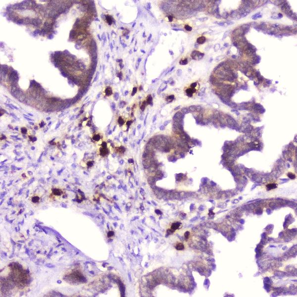 Figure 2. IHC analysis of Ribonuclease 3 using anti-Ribonuclease 3 antibody (A03115-1). Ribonuclease 3 was detected in paraffin-embedded section of human ovary cancer tissue. Heat mediated antigen retrieval was performed in citrate buffer (pH6, epitope retrieval solution) for 20 mins. The tissue section was blocked with 10% goat serum. The tissue section was then incubated with 2microg/ml rabbit anti-Ribonuclease 3 Antibody (A03115-1) overnight at 4°C. Biotinylated goat anti-rabbit IgG was used as secondary antibody and incubated for 30 minutes at 37°C. The tissue section was developed using Strepavidin-Biotin-Complex (SABC)(Catalog # SA1022) with DAB as the chromogen. Figure 2. IHC analysis of Ribonuclease 3 using anti-Ribonuclease 3 antibody (A03115-1). Ribonuclease 3 was detected in paraffin-embedded section of human ovary cancer tissue. Heat mediated antigen retrieval was performed in citrate buffer (pH6, epitope retrieval solution) for 20 mins. The tissue section was blocked with 10% goat serum. The tissue section was then incubated with 2microg/ml rabbit anti-Ribonuclease 3 Antibody (A03115-1) overnight at 4°C. Biotinylated goat anti-rabbit IgG was used as secondary antibody and incubated for 30 minutes at 37°C. The tissue section was developed using Strepavidin-Biotin-Complex (SABC)(Catalog # SA1022) with DAB as the chromogen.