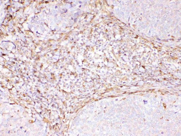 IHC analysis of Cyclophilin B using anti-Cyclophilin B antibody (A03229). Cyclophilin B was detected in paraffin-embedded section of human lung cancer tissue. Heat mediated antigen retrieval was performed in citrate buffer (pH6, epitope retrieval solution) for 20 mins. The tissue section was blocked with 10% goat serum. The tissue section was then incubated with 1ug/ml rabbit anti-Cyclophilin B Antibody (A03229) overnight at 4 Biotinylated goat anti-rabbit IgG was used as secondary antibody and incubated for 30 minutes at 37 The tissue section was developed using Strepavidin-Biotin-Complex (SABC)(Catalog # SA1022) with DAB as the chromogen.