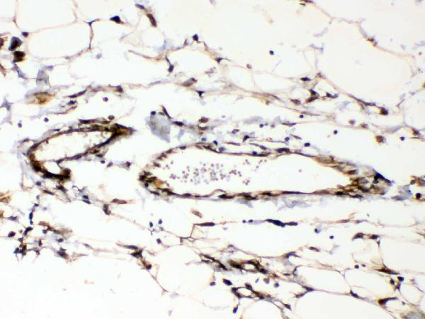 Figure 4. IHC analysis of Cyclophilin B using anti-Cyclophilin B antibody (A03229). Cyclophilin B was detected in paraffin-embedded section of human mammary cancer tissue. Heat mediated antigen retrieval was performed in citrate buffer (pH6, epitope retrieval solution) for 20 mins. The tissue section was blocked with 10% goat serum. The tissue section was then incubated with 1ug/ml rabbit anti-Cyclophilin B Antibody (A03229) overnight at 4 Biotinylated goat anti-rabbit IgG was used as secondary antibody and incubated for 30 minutes at 37 The tissue section was developed using Strepavidin-Biotin-Complex (SABC)(Catalog # SA1022) with DAB as the chromogen.