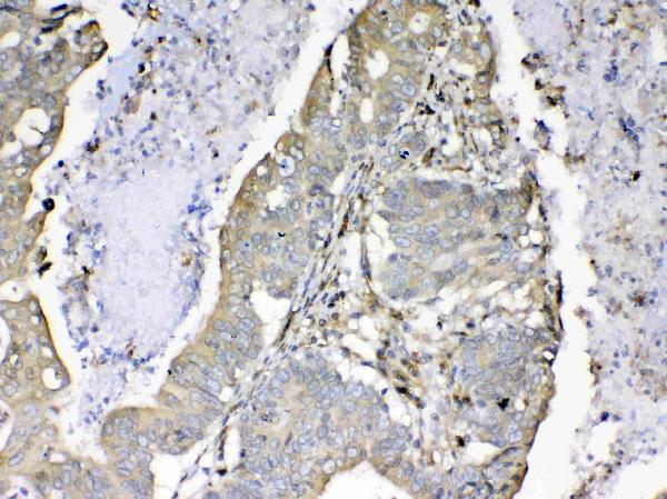 Figure 5. IHC analysis of Cyclophilin B using anti-Cyclophilin B antibody (A03229). Cyclophilin B was detected in paraffin-embedded section of human rectal cancer tissue. Heat mediated antigen retrieval was performed in citrate buffer (pH6, epitope retrieval solution) for 20 mins. The tissue section was blocked with 10% goat serum. The tissue section was then incubated with 1ug/ml rabbit anti-Cyclophilin B Antibody (A03229) overnight at 4 Biotinylated goat anti-rabbit IgG was used as secondary antibody and incubated for 30 minutes at 37 The tissue section was developed using Strepavidin-Biotin-Complex (SABC)(Catalog # SA1022) with DAB as the chromogen.