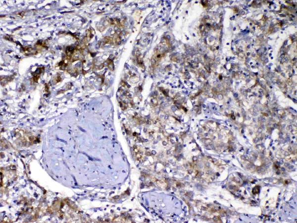 Figure 2. IHC analysis of Vitamin D Binding protein using anti-Vitamin D Binding protein antibody (A03364-1). Vitamin D Binding protein was detected in paraffin-embedded section of human liver cancer tissue. Heat mediated antigen retrieval was performed in citrate buffer (pH6, epitope retrieval solution) for 20 mins. The tissue section was blocked with 10% goat serum. The tissue section was then incubated with 1ug/ml rabbit anti-Vitamin D Binding protein Antibody (A03364-1) overnight at 4 Biotinylated goat anti-rabbit IgG was used as secondary antibody and incubated for 30 minutes at 37 The tissue section was developed using Strepavidin-Biotin-Complex (SABC)(Catalog # SA1022) with DAB as the chromogen.