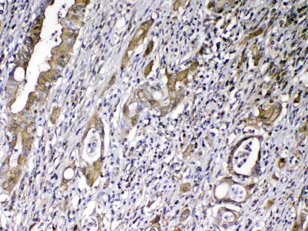 Figure 5. IHC analysis of Vitamin D Binding protein using anti-Vitamin D Binding protein antibody (A03364-1). Vitamin D Binding protein was detected in paraffin-embedded section of human rectal cancer tissue. Heat mediated antigen retrieval was performed in citrate buffer (pH6, epitope retrieval solution) for 20 mins. The tissue section was blocked with 10% goat serum. The tissue section was then incubated with 1ug/ml rabbit anti-Vitamin D Binding protein Antibody (A03364-1) overnight at 4 Biotinylated goat anti-rabbit IgG was used as secondary antibody and incubated for 30 minutes at 37 The tissue section was developed using Strepavidin-Biotin-Complex (SABC)(Catalog # SA1022) with DAB as the chromogen.