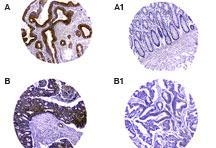 Formalin-fixed, paraffin-embedded tumor/normal adjacent tissue cores from a human colon tissue microarray stained for TUCAN/CARD8 expression at 1:2000. A and B are tumor tissue cores. A1 and B1 are the matched normal adjacent cores from A and B, respectively. Hematoxylin-eosin counterstain.