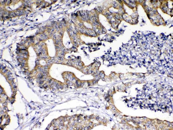 IHC analysis of TNFSF18 using anti-TNFSF18 antibody (A04408-1). TNFSF18 was detected in paraffin-embedded section of human colon cancer tissue. Heat mediated antigen retrieval was performed in citrate buffer (pH6, epitope retrieval solution) for 20 mins. The tissue section was blocked with 10% goat serum. The tissue section was then incubated with 1ug/ml rabbit anti-TNFSF18 Antibody (A04408-1) overnight at 4 Biotinylated goat anti-rabbit IgG was used as secondary antibody and incubated for 30 minutes at 37 The tissue section was developed using Strepavidin-Biotin-Complex (SABC)(Catalog # SA1022) with DAB as the chromogen.