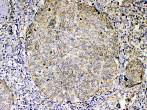 IHC analysis of TNFSF18 using anti-TNFSF18 antibody (A04408-1). TNFSF18 was detected in paraffin-embedded section of human lung cancer tissue. Heat mediated antigen retrieval was performed in citrate buffer (pH6, epitope retrieval solution) for 20 mins. The tissue section was blocked with 10% goat serum. The tissue section was then incubated with 1ug/ml rabbit anti-TNFSF18 Antibody (A04408-1) overnight at 4 Biotinylated goat anti-rabbit IgG was used as secondary antibody and incubated for 30 minutes at 37 The tissue section was developed using Strepavidin-Biotin-Complex (SABC)(Catalog # SA1022) with DAB as the chromogen.