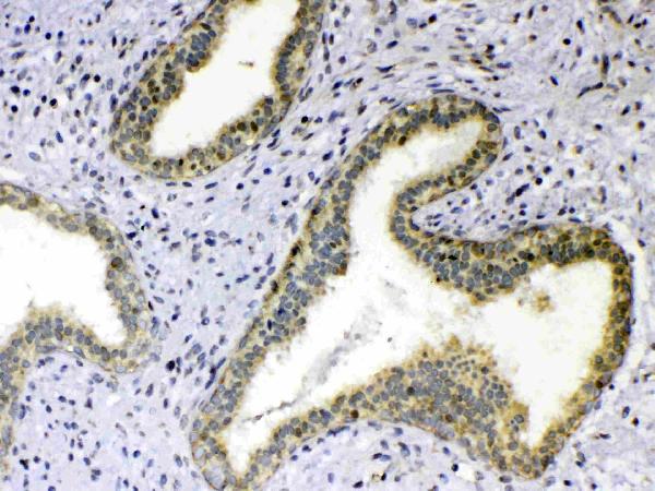 IHC analysis of TNFSF18 using anti-TNFSF18 antibody (A04408-1). TNFSF18 was detected in paraffin-embedded section of human mammary cancer tissue. Heat mediated antigen retrieval was performed in citrate buffer (pH6, epitope retrieval solution) for 20 mins. The tissue section was blocked with 10% goat serum. The tissue section was then incubated with 1ug/ml rabbit anti-TNFSF18 Antibody (A04408-1) overnight at 4 Biotinylated goat anti-rabbit IgG was used as secondary antibody and incubated for 30 minutes at 37 The tissue section was developed using Strepavidin-Biotin-Complex (SABC)(Catalog # SA1022) with DAB as the chromogen.