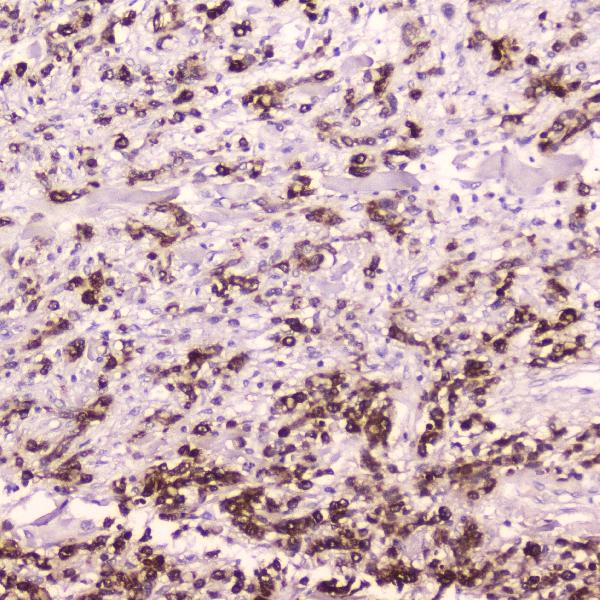 IHC analysis of Cathepsin E using anti-Cathepsin E antibody (A04874-1). Cathepsin E was detected in paraffin-embedded section of human gastric cancer tissue. Heat mediated antigen retrieval was performed in citrate buffer (pH6, epitope retrieval solution) for 20 mins. The tissue section was blocked with 10% goat serum. The tissue section was then incubated with 2μg/ml rabbit anti-Cathepsin E Antibody (A04874-1) overnight at 4℃. Biotinylated goat anti-rabbit IgG was used as secondary antibody and incubated for 30 minutes at 37℃. The tissue section was developed using Strepavidin-Biotin-Complex (SABC)(Catalog # SA1022) with DAB as the chromogen.