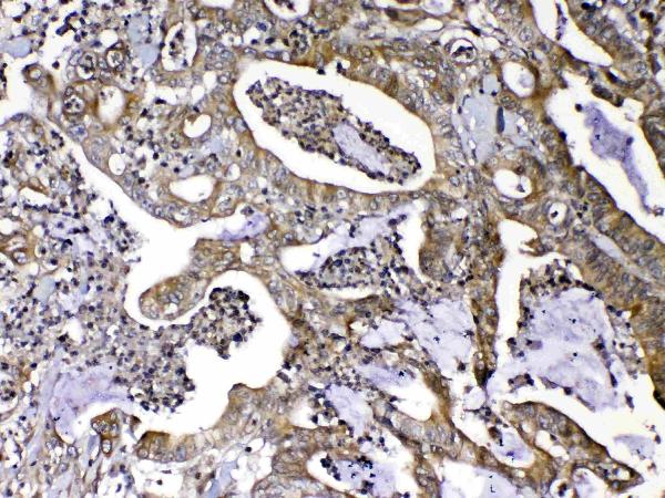 IHC analysis of MMP16 using anti-MMP16 antibody (A05065). MMP16 was detected in paraffin-embedded section of human colon cancer tissue. Heat mediated antigen retrieval was performed in citrate buffer (pH6, epitope retrieval solution) for 20 mins. The tissue section was blocked with 10% goat serum. The tissue section was then incubated with 1ug/ml rabbit anti-MMP16 Antibody (A05065) overnight at 4 Biotinylated goat anti-rabbit IgG was used as secondary antibody and incubated for 30 minutes at 37 The tissue section was developed using Strepavidin-Biotin-Complex (SABC)(Catalog # SA1022) with DAB as the chromogen.
