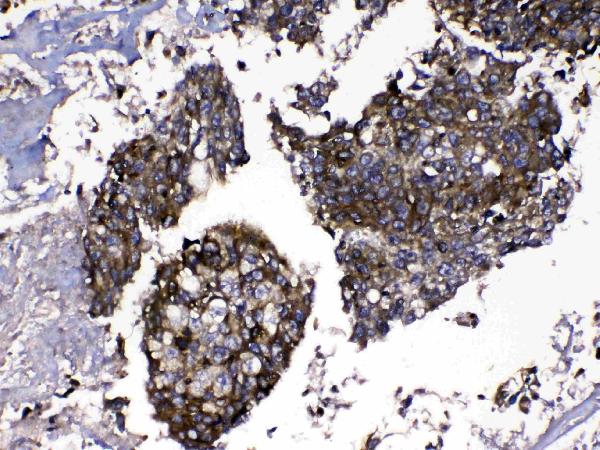 IHC analysis of MMP16 using anti-MMP16 antibody (A05065). MMP16 was detected in paraffin-embedded section of human lung cancer tissue. Heat mediated antigen retrieval was performed in citrate buffer (pH6, epitope retrieval solution) for 20 mins. The tissue section was blocked with 10% goat serum. The tissue section was then incubated with 1ug/ml rabbit anti-MMP16 Antibody (A05065) overnight at 4 Biotinylated goat anti-rabbit IgG was used as secondary antibody and incubated for 30 minutes at 37 The tissue section was developed using Strepavidin-Biotin-Complex (SABC)(Catalog # SA1022) with DAB as the chromogen.
