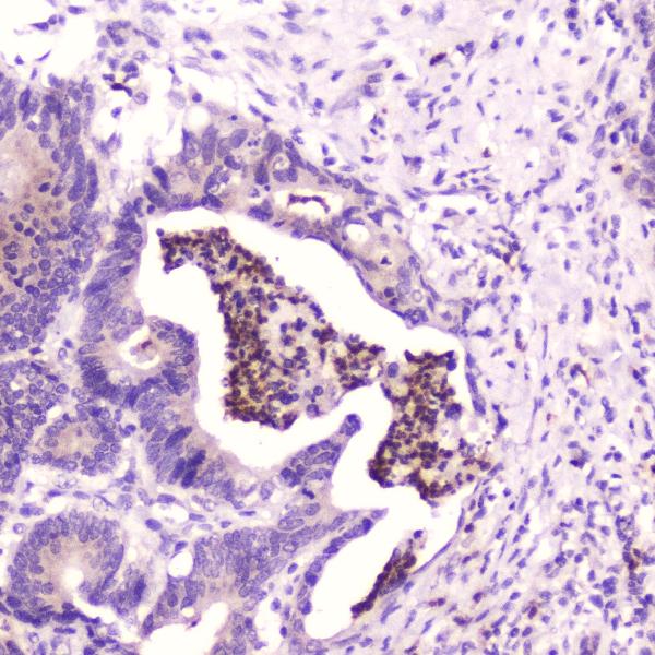 IHC analysis of SPARCL1 using anti-SPARCL1 antibody (A05726). SPARCL1 was detected in paraffin-embedded section of human colon cancer tissue. Heat mediated antigen retrieval was performed in citrate buffer (pH6, epitope retrieval solution) for 20 mins. The tissue section was blocked with 10% goat serum. The tissue section was then incubated with 2μg/ml rabbit anti-SPARCL1 Antibody (A05726) overnight at 4℃. Biotinylated goat anti-rabbit IgG was used as secondary antibody and incubated for 30 minutes at 37℃. The tissue section was developed using Strepavidin-Biotin-Complex (SABC)(Catalog # SA1022) with DAB as the chromogen.