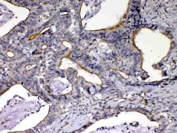 IHC analysis of NOV/CCN3 using anti-NOV/CCN3 antibody (A06319-1). NOV/CCN3 was detected in paraffin-embedded section of human intestinal cancer tissue. Heat mediated antigen retrieval was performed in citrate buffer (pH6, epitope retrieval solution) for 20 mins. The tissue section was blocked with 10% goat serum. The tissue section was then incubated with 1μg/ml rabbit anti-NOV/CCN3 Antibody (A06319-1) overnight at 4°C. Biotinylated goat anti-rabbit IgG was used as secondary antibody and incubated for 30 minutes at 37°C. The tissue section was developed using Strepavidin-Biotin-Complex (SABC)(Catalog # SA1022) with DAB as the chromogen.