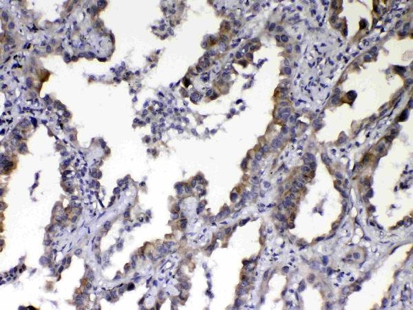 IHC analysis of NOV/CCN3 using anti-NOV/CCN3 antibody (A06319-1). NOV/CCN3 was detected in paraffin-embedded section of human lung cancer tissue. Heat mediated antigen retrieval was performed in citrate buffer (pH6, epitope retrieval solution) for 20 mins. The tissue section was blocked with 10% goat serum. The tissue section was then incubated with 1μg/ml rabbit anti-NOV/CCN3 Antibody (A06319-1) overnight at 4°C. Biotinylated goat anti-rabbit IgG was used as secondary antibody and incubated for 30 minutes at 37°C. The tissue section was developed using Strepavidin-Biotin-Complex (SABC)(Catalog # SA1022) with DAB as the chromogen.