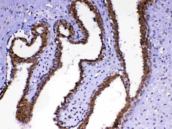 IHC analysis of MED4 using anti-MED4 antibody (A06467-1). MED4 was detected in paraffin-embedded section of human mammary cancer tissue. Heat mediated antigen retrieval was performed in citrate buffer (pH6, epitope retrieval solution) for 20 mins. The tissue section was blocked with 10% goat serum. The tissue section was then incubated with 1ug/ml rabbit anti-MED4 Antibody (A06467-1) overnight at 4 Biotinylated goat anti-rabbit IgG was used as secondary antibody and incubated for 30 minutes at 37 The tissue section was developed using Strepavidin-Biotin-Complex (SABC)(Catalog # SA1022) with DAB as the chromogen.