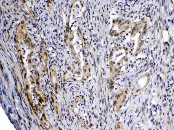 IHC analysis of MED4 using anti-MED4 antibody (A06467-1). MED4 was detected in paraffin-embedded section of human rectal cancer tissue. Heat mediated antigen retrieval was performed in citrate buffer (pH6, epitope retrieval solution) for 20 mins. The tissue section was blocked with 10% goat serum. The tissue section was then incubated with 1ug/ml rabbit anti-MED4 Antibody (A06467-1) overnight at 4 Biotinylated goat anti-rabbit IgG was used as secondary antibody and incubated for 30 minutes at 37 The tissue section was developed using Strepavidin-Biotin-Complex (SABC)(Catalog # SA1022) with DAB as the chromogen.