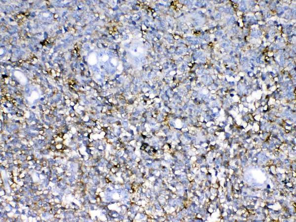 IHC analysis of Neurocan using anti-Neurocan antibody (A06700-1). Neurocan was detected in paraffin-embedded section of human glioma tissue. Heat mediated antigen retrieval was performed in citrate buffer (pH6, epitope retrieval solution) for 20 mins. The tissue section was blocked with 10% goat serum. The tissue section was then incubated with 1ug/ml rabbit anti-Neurocan Antibody (A06700-1) overnight at 4 Biotinylated goat anti-rabbit IgG was used as secondary antibody and incubated for 30 minutes at 37 The tissue section was developed using Strepavidin-Biotin-Complex (SABC)(Catalog # SA1022) with DAB as the chromogen.