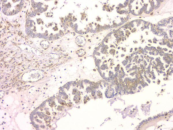 IHC analysis of SRCIN1 using anti-SRCIN1 antibody (A08110-1). SRCIN1 was detected in paraffin-embedded section of human ovary cancer tissue. Heat mediated antigen retrieval was performed in citrate buffer (pH6, epitope retrieval solution) for 20 mins. The tissue section was blocked with 10% goat serum. The tissue section was then incubated with 1μg/ml rabbit anti-SRCIN1 Antibody (A08110-1) overnight at 4°C. Biotinylated goat anti-rabbit IgG was used as secondary antibody and incubated for 30 minutes at 37°C. The tissue section was developed using Strepavidin-Biotin-Complex (SABC)(Catalog # SA1022) with DAB as the chromogen.