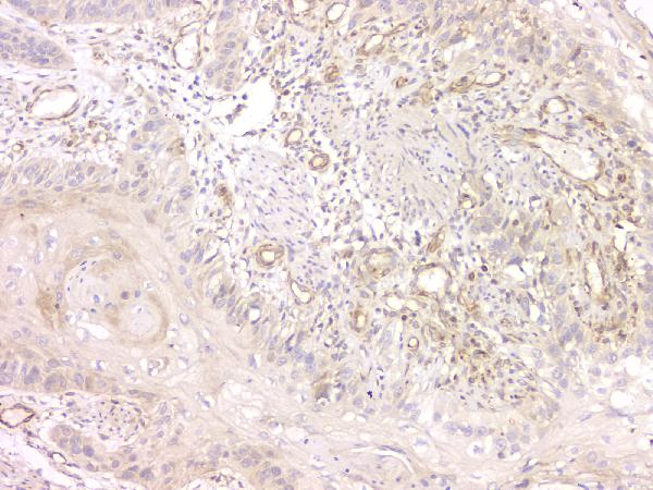 IHC analysis of SRCIN1 using anti-SRCIN1 antibody (A08110-1). SRCIN1 was detected in paraffin-embedded section of human oesophagus squama cancer tissue. Heat mediated antigen retrieval was performed in citrate buffer (pH6, epitope retrieval solution) for 20 mins. The tissue section was blocked with 10% goat serum. The tissue section was then incubated with 1μg/ml rabbit anti-SRCIN1 Antibody (A08110-1) overnight at 4°C. Biotinylated goat anti-rabbit IgG was used as secondary antibody and incubated for 30 minutes at 37°C. The tissue section was developed using Strepavidin-Biotin-Complex (SABC)(Catalog # SA1022) with DAB as the chromogen.