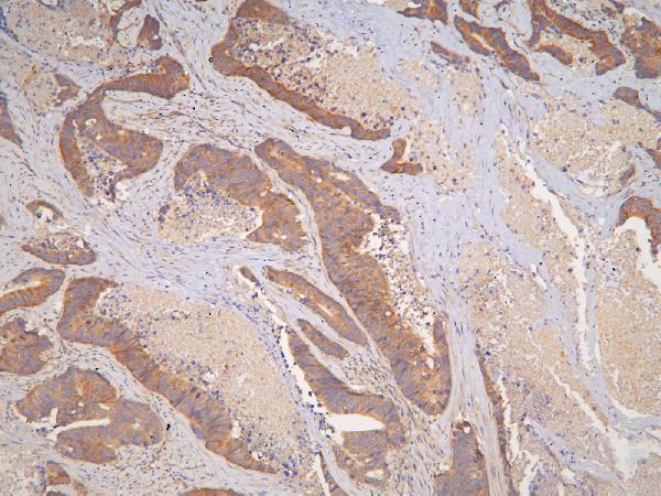 Figure 2. IHC analysis of IL31 using anti-IL31 antibody (A08339-1). IL31 was detected in paraffin-embedded section of human colon cancer tissues. Heat mediated antigen retrieval was performed in citrate buffer (pH6, epitope retrieval solution) for 20 mins. The tissue section was blocked with 10% goat serum. The tissue section was then incubated with 1microg/ml rabbit anti-IL31 Antibody (A08339-1) overnight at 4°C. Biotinylated goat anti-rabbit IgG was used as secondary antibody and incubated for 30 minutes at 37°C. The tissue section was developed using Strepavidin-Biotin-Complex (SABC)(Catalog # SA1022) with DAB as the chromogen.