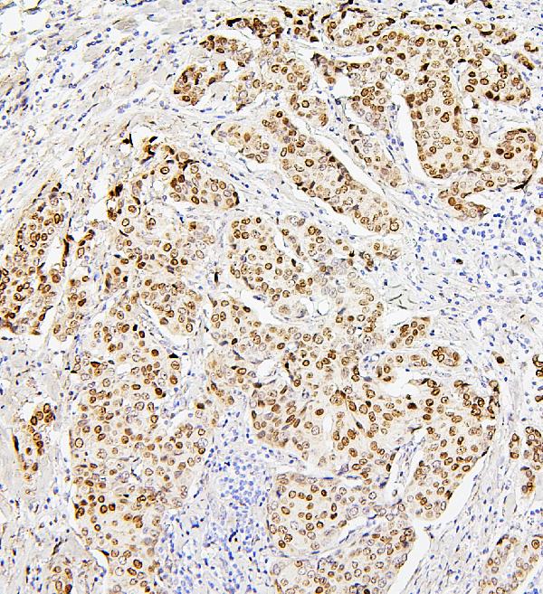 Figure 10. IHC analysis of H1F0 using anti-H1F0 antibody (A08821-1). H1F0 was detected in paraffin-embedded section of human mammary cancer tissues. Heat mediated antigen retrieval was performed in citrate buffer (pH6, epitope retrieval solution) for 20 mins. The tissue section was blocked with 10% goat serum. The tissue section was then incubated with 1microg/ml rabbit anti-H1F0 Antibody (A08821-1) overnight at 4°C. Biotinylated goat anti-rabbit IgG was used as secondary antibody and incubated for 30 minutes at 37°C. The tissue section was developed using Strepavidin-Biotin-Complex (SABC)(Catalog # SA1022) with DAB as the chromogen.
