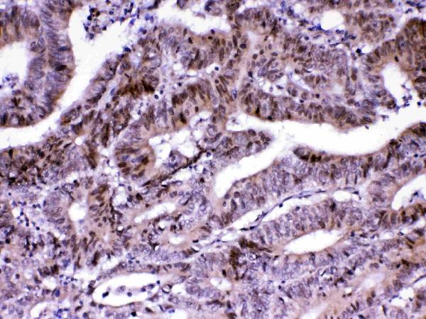 IHC analysis of MED18 using anti-MED18 antibody (A10600-2). MED18 was detected in paraffin-embedded section of human intestinal cancer tissue. Heat mediated antigen retrieval was performed in citrate buffer (pH6, epitope retrieval solution) for 20 mins. The tissue section was blocked with 10% goat serum. The tissue section was then incubated with 1ug/ml rabbit anti-MED18 Antibody (A10600-2) overnight at 4 Biotinylated goat anti-rabbit IgG was used as secondary antibody and incubated for 30 minutes at 37 The tissue section was developed using Strepavidin-Biotin-Complex (SABC)(Catalog # SA1022) with DAB as the chromogen.