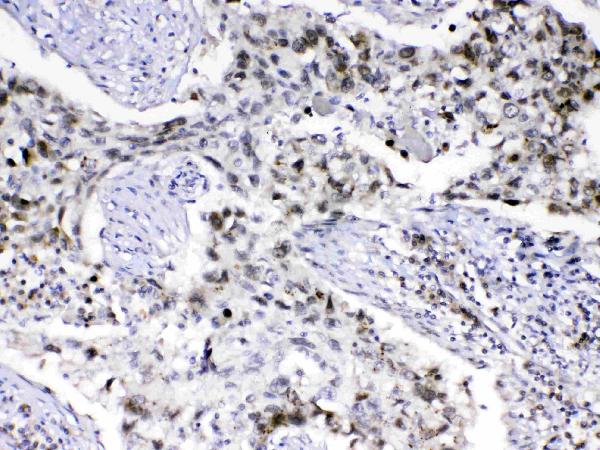 IHC analysis of MED18 using anti-MED18 antibody (A10600-2). MED18 was detected in paraffin-embedded section of human lung cancer tissue. Heat mediated antigen retrieval was performed in citrate buffer (pH6, epitope retrieval solution) for 20 mins. The tissue section was blocked with 10% goat serum. The tissue section was then incubated with 1ug/ml rabbit anti-MED18 Antibody (A10600-2) overnight at 4 Biotinylated goat anti-rabbit IgG was used as secondary antibody and incubated for 30 minutes at 37 The tissue section was developed using Strepavidin-Biotin-Complex (SABC)(Catalog # SA1022) with DAB as the chromogen.