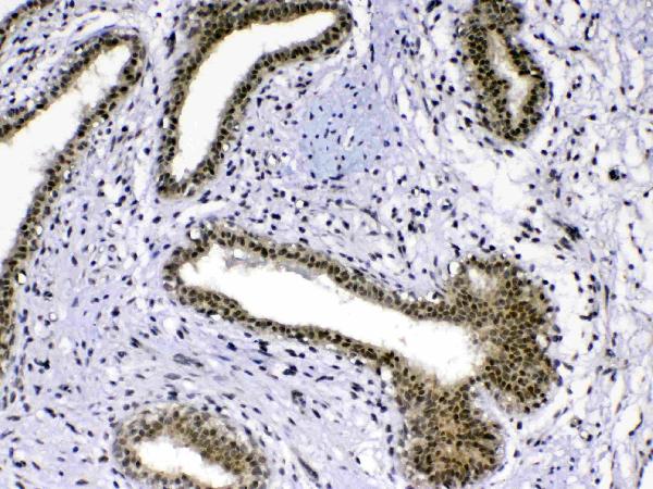 IHC analysis of MED18 using anti-MED18 antibody (A10600-2). MED18 was detected in paraffin-embedded section of human mammary cancer tissue. Heat mediated antigen retrieval was performed in citrate buffer (pH6, epitope retrieval solution) for 20 mins. The tissue section was blocked with 10% goat serum. The tissue section was then incubated with 1ug/ml rabbit anti-MED18 Antibody (A10600-2) overnight at 4 Biotinylated goat anti-rabbit IgG was used as secondary antibody and incubated for 30 minutes at 37 The tissue section was developed using Strepavidin-Biotin-Complex (SABC)(Catalog # SA1022) with DAB as the chromogen.