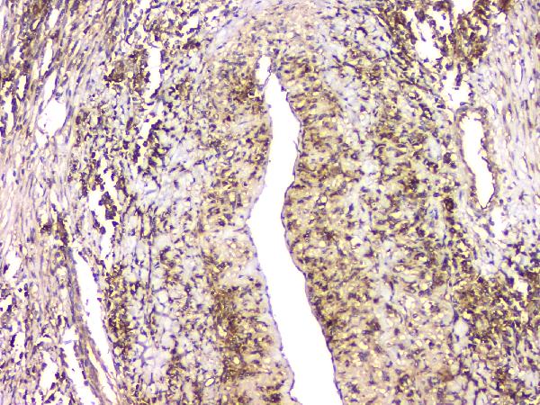 IHC analysis of HECTD3 using anti-HECTD3 antibody (A11560). HECTD3 was detected in paraffin-embedded section of human lung cancer tissue. Heat mediated antigen retrieval was performed in citrate buffer (pH6, epitope retrieval solution) for 20 mins. The tissue section was blocked with 10% goat serum. The tissue section was then incubated with 1μg/ml rabbit anti-HECTD3 Antibody (A11560) overnight at 4°C. Biotinylated goat anti-rabbit IgG was used as secondary antibody and incubated for 30 minutes at 37°C. The tissue section was developed using Strepavidin-Biotin-Complex (SABC)(Catalog # SA1022) with DAB as the chromogen.