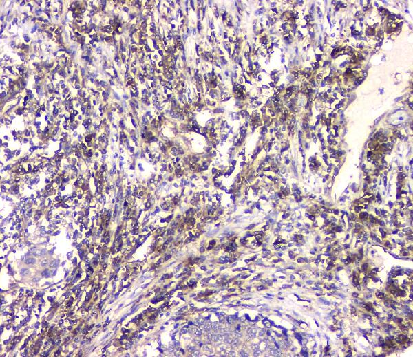 IHC analysis of HECTD3 using anti-HECTD3 antibody (A11560). HECTD3 was detected in paraffin-embedded section of human lung cancer tissue. Heat mediated antigen retrieval was performed in citrate buffer (pH6, epitope retrieval solution) for 20 mins. The tissue section was blocked with 10% goat serum. The tissue section was then incubated with 1μg/ml rabbit anti-HECTD3 Antibody (A11560) overnight at 4°C. Biotinylated goat anti-rabbit IgG was used as secondary antibody and incubated for 30 minutes at 37°C. The tissue section was developed using Strepavidin-Biotin-Complex (SABC)(Catalog # SA1022) with DAB as the chromogen.