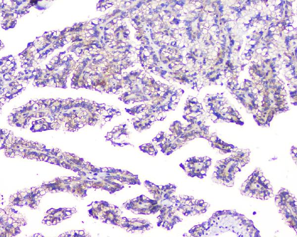 IHC analysis of EVA1A using anti-EVA1A antibody (A11580-1). EVA1A was detected in paraffin-embedded section of human renal cancer tissue. Heat mediated antigen retrieval was performed in citrate buffer (pH6, epitope retrieval solution) for 20 mins. The tissue section was blocked with 10% goat serum. The tissue section was then incubated with 1μg/ml rabbit anti-EVA1A Antibody (A11580-1) overnight at 4°C. Biotinylated goat anti-rabbit IgG was used as secondary antibody and incubated for 30 minutes at 37°C. The tissue section was developed using Strepavidin-Biotin-Complex (SABC)(Catalog # SA1022) with DAB as the chromogen.