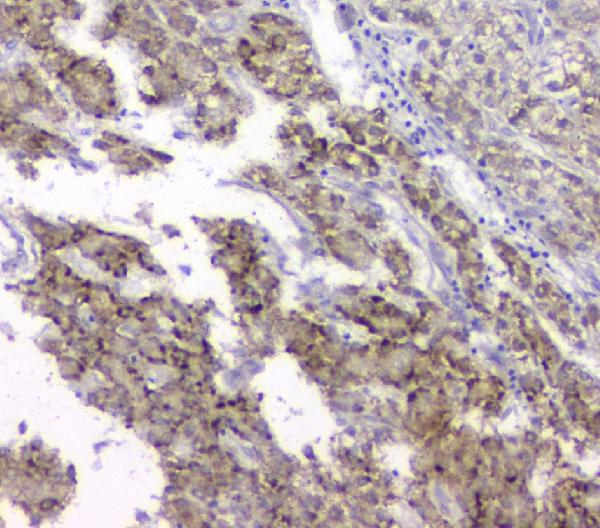 IHC analysis of TIMM17A using anti-TIMM17A antibody (A12168-1). TIMM17A was detected in paraffin-embedded section of human liver cancer tissue. Heat mediated antigen retrieval was performed in citrate buffer (pH6, epitope retrieval solution) for 20 mins. The tissue section was blocked with 10% goat serum. The tissue section was then incubated with 1μg/ml rabbit anti-TIMM17A Antibody (A12168-1) overnight at 4°C. Biotinylated goat anti-rabbit IgG was used as secondary antibody and incubated for 30 minutes at 37°C. The tissue section was developed using Strepavidin-Biotin-Complex (SABC)(Catalog # SA1022) with DAB as the chromogen.