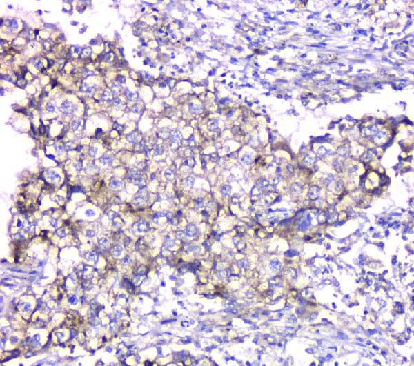 IHC analysis of TIMM17A using anti-TIMM17A antibody (A12168-1). TIMM17A was detected in paraffin-embedded section of human lung cancer tissue. Heat mediated antigen retrieval was performed in citrate buffer (pH6, epitope retrieval solution) for 20 mins. The tissue section was blocked with 10% goat serum. The tissue section was then incubated with 1μg/ml rabbit anti-TIMM17A Antibody (A12168-1) overnight at 4°C. Biotinylated goat anti-rabbit IgG was used as secondary antibody and incubated for 30 minutes at 37°C. The tissue section was developed using Strepavidin-Biotin-Complex (SABC)(Catalog # SA1022) with DAB as the chromogen.