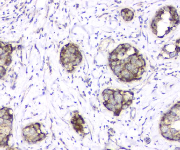IHC analysis of TIMM17A using anti-TIMM17A antibody (A12168-1). TIMM17A was detected in paraffin-embedded section of human mammary cancer tissue. Heat mediated antigen retrieval was performed in citrate buffer (pH6, epitope retrieval solution) for 20 mins. The tissue section was blocked with 10% goat serum. The tissue section was then incubated with 1μg/ml rabbit anti-TIMM17A Antibody (A12168-1) overnight at 4°C. Biotinylated goat anti-rabbit IgG was used as secondary antibody and incubated for 30 minutes at 37°C. The tissue section was developed using Strepavidin-Biotin-Complex (SABC)(Catalog # SA1022) with DAB as the chromogen.