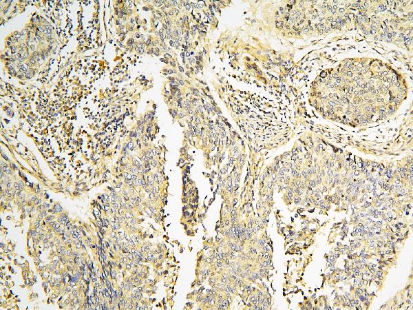 IHC analysis of CPAMD8 using anti-CPAMD8 antibody (A12898). CPAMD8 was detected in paraffin-embedded section of human lung cancer tissue. Heat mediated antigen retrieval was performed in citrate buffer (pH6, epitope retrieval solution) for 20 mins. The tissue section was blocked with 10% goat serum. The tissue section was then incubated with 1μg/ml rabbit anti-CPAMD8 Antibody (A12898) overnight at 4°C. Biotinylated goat anti-rabbit IgG was used as secondary antibody and incubated for 30 minutes at 37°C. The tissue section was developed using Strepavidin-Biotin-Complex (SABC)(Catalog # SA1022) with DAB as the chromogen.