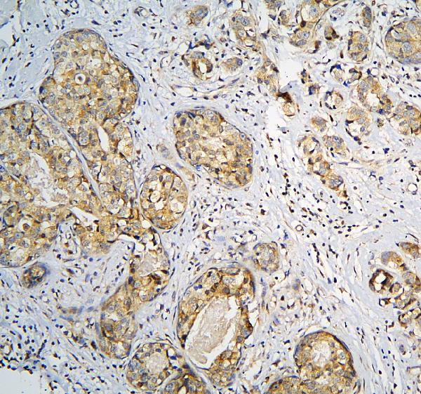 IHC analysis of CPAMD8 using anti-CPAMD8 antibody (A12898). CPAMD8 was detected in paraffin-embedded section of human mammary cancer tissue. Heat mediated antigen retrieval was performed in citrate buffer (pH6, epitope retrieval solution) for 20 mins. The tissue section was blocked with 10% goat serum. The tissue section was then incubated with 1μg/ml rabbit anti-CPAMD8 Antibody (A12898) overnight at 4°C. Biotinylated goat anti-rabbit IgG was used as secondary antibody and incubated for 30 minutes at 37°C. The tissue section was developed using Strepavidin-Biotin-Complex (SABC)(Catalog # SA1022) with DAB as the chromogen.