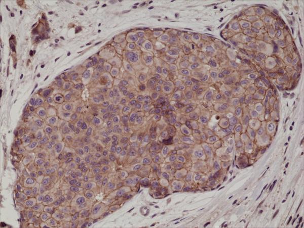  IHC resultImmunohistochemical staining of formalin fixed and paraffin embedded human breast cancer tissue sections using Anti-E-cadherin RM244 at a 1:1000 dilution