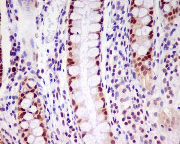 Immunohistochemical analysis of paraffin-embedded human colon, using PCNA Antibody