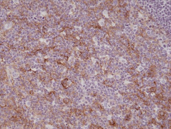  IHC resultImmunohistochemical staining of formalin fixed and paraffin embedded human tonsil tissue sections using anti-CD11b rabbit monoclonal antibody (clone RM290) at a 1:200 dilution