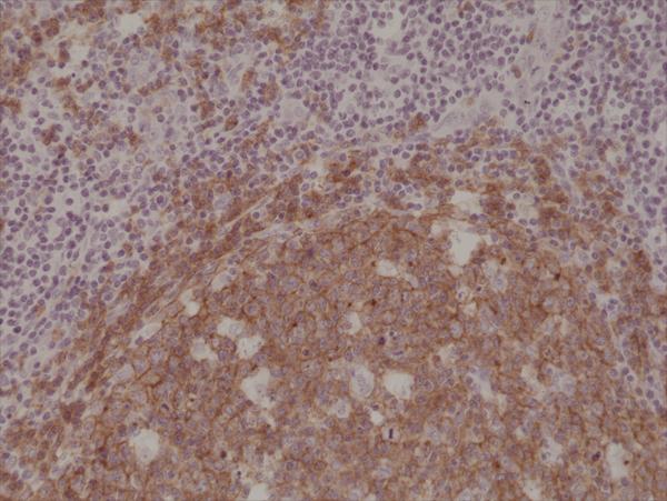 Figure 2. IHC result Immunohistochemical staining of formalin fixed and paraffin embedded human Tonsil tissue section using anti-CD19 rabbit monoclonal antibody (Clone RM332) at a 1:1000 dilution. Figure 2. IHC result Immunohistochemical staining of formalin fixed and paraffin embedded human Tonsil tissue section using anti-CD19 rabbit monoclonal antibody (Clone RM332) at a 1:1000 dilution.