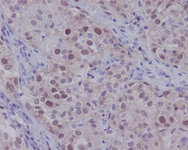 Immunohistochemical analysis of paraffin-embedded human beast carcinoma, using CDK2 Antibody