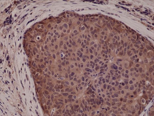 IHC resultImmunohistochemical staining of formalin fixed and paraffin embedded human breast cancer tissue sections using Anti-p38 MAPK RM245 at a 1:5000 dilution