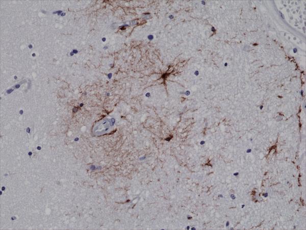  IHC resultImmunohistochemical staining of formalin fixed and paraffin embedded human brain tissue sections using Anti-GFAP RM246 at a 1:500 dilution