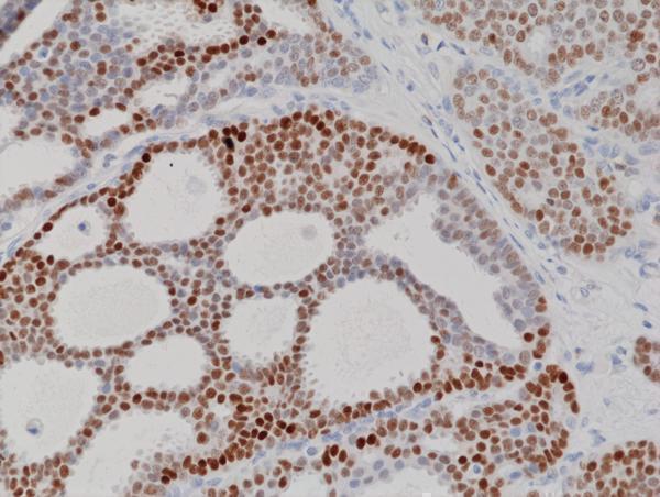  IHC resultImmunohistochemical staining of formalin fixed and paraffin embedded human breast cancer tissue section using anti-Progesterone Receptor (PR) rabbit monoclonal antibody (clone RM357) at a 1:100 dilution